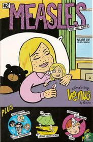 Measles 2